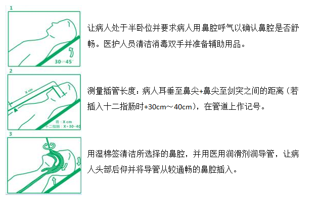 可插气管插管喉罩