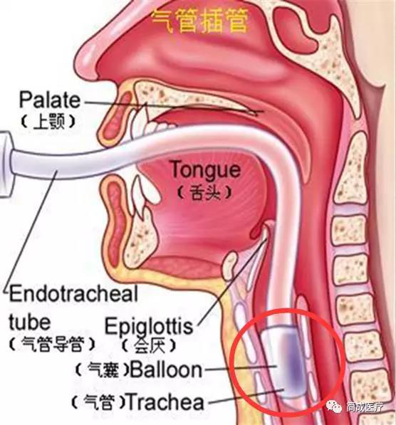 可插气管插管喉罩